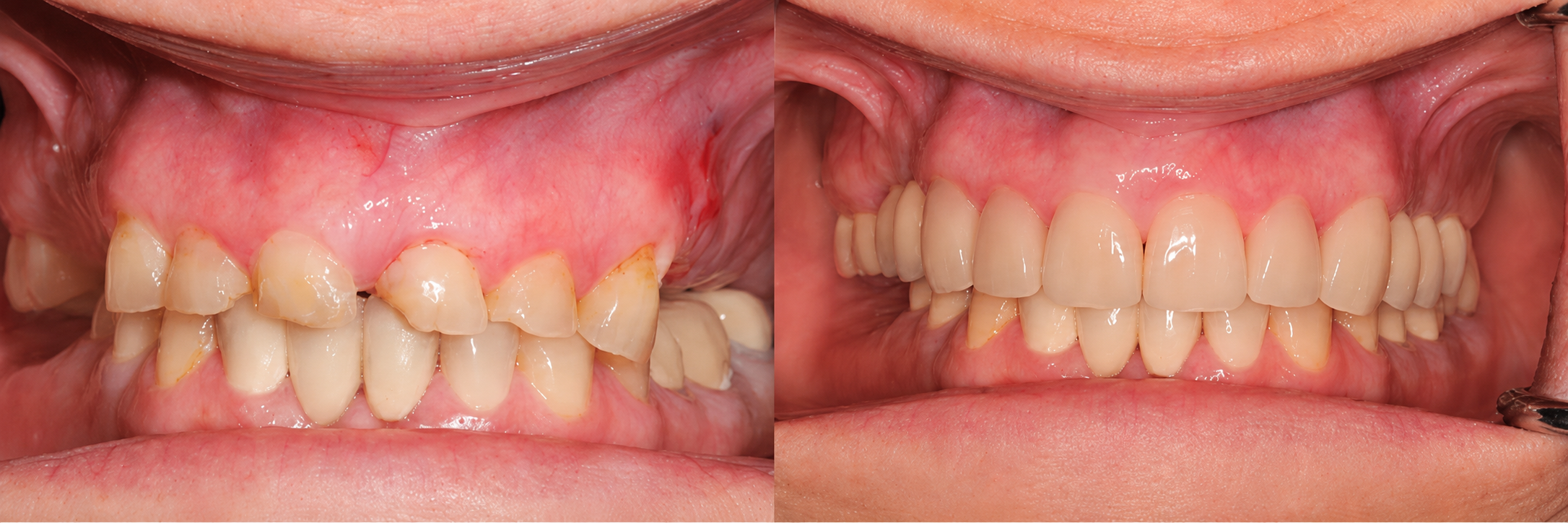 Before-and-after comparison of a patient's teeth (case 1)