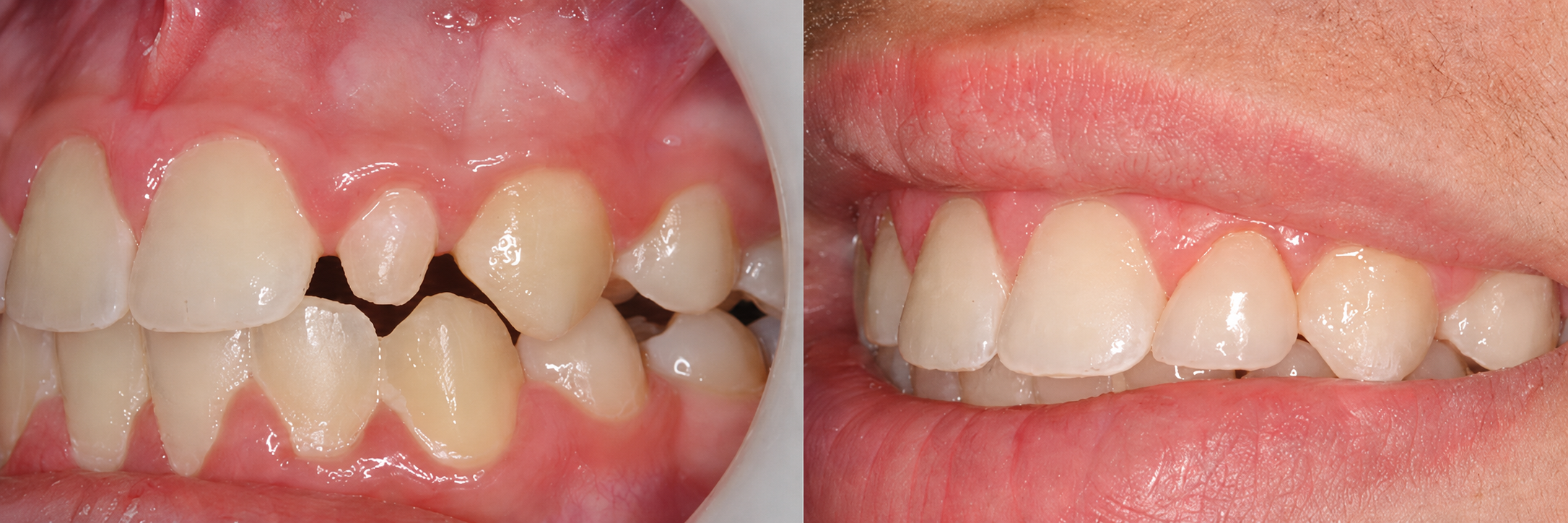 Before-and-after comparison of a patient's teeth (case 2)