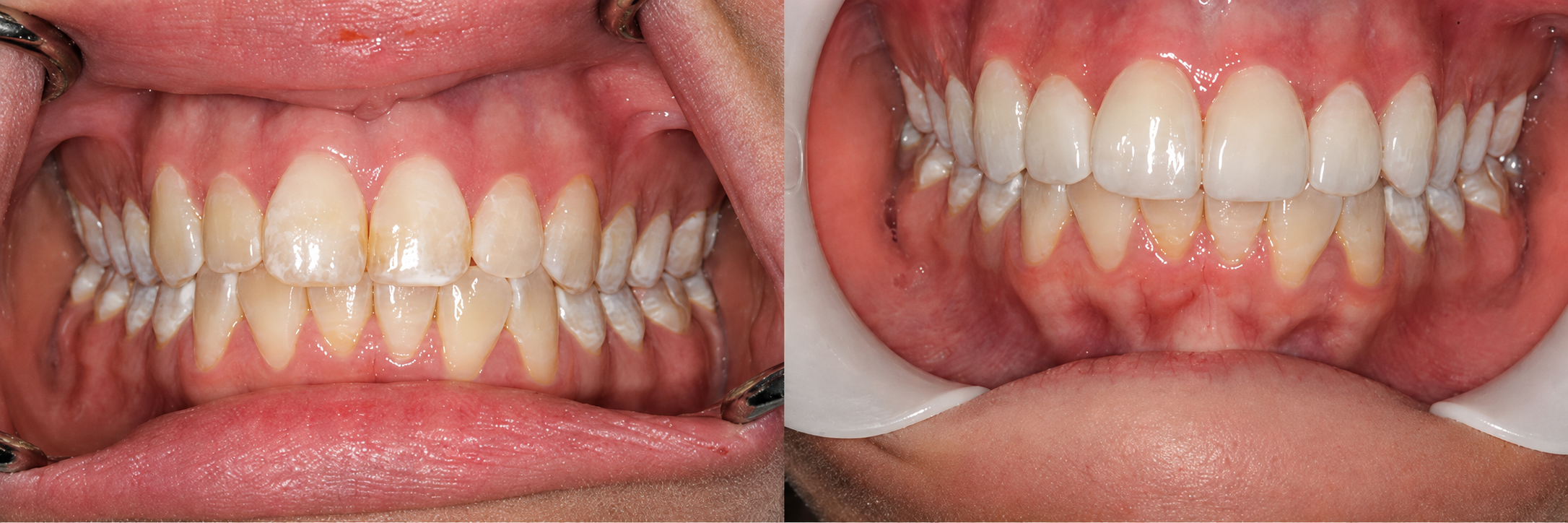 Before-and-after comparison of a patient's teeth (case 3)