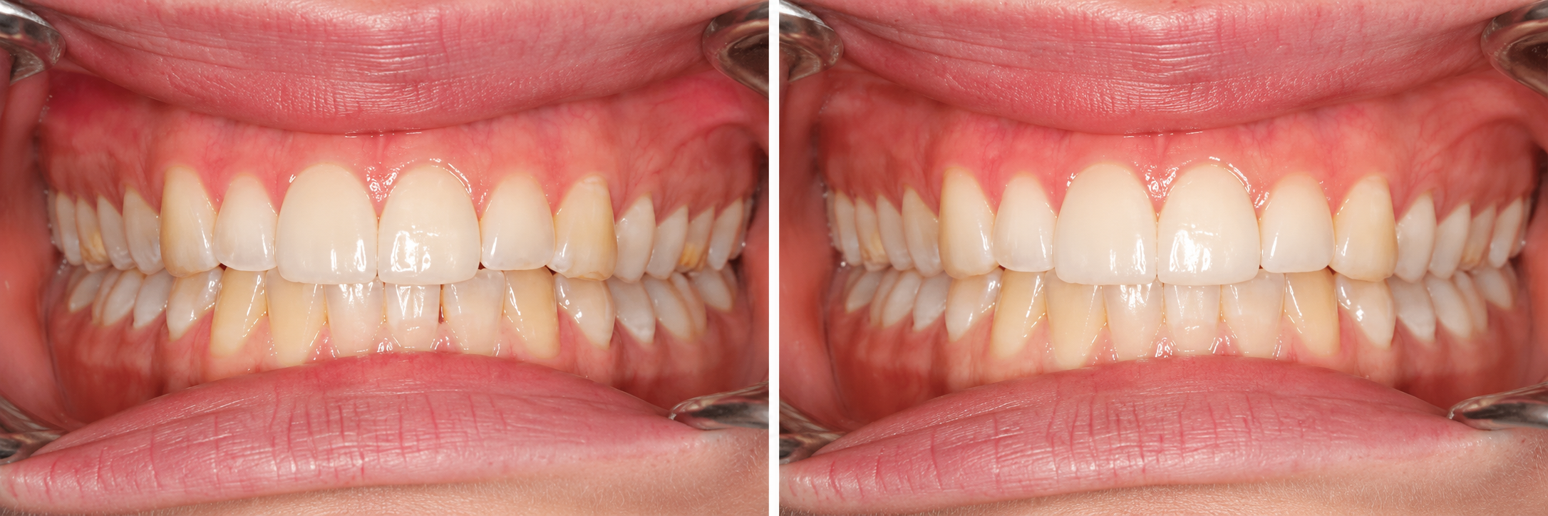 Before-and-after comparison of a patient's teeth (case 4)