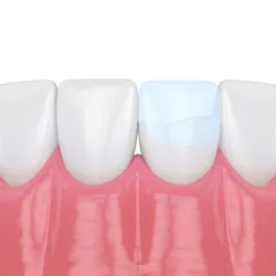 Composite resin being applied to the edge of a front tooth