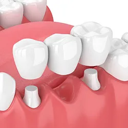 A tooth-supported bridge with crowns over two prepared teeth spanning a gap