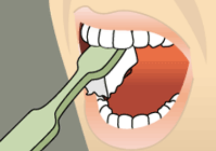 Brushing the inner surfaces of the teeth