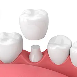 A full-coverage crown positioned above a prepared tooth