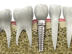 A single titanium implant post and crown set among natural teeth in the jawbone