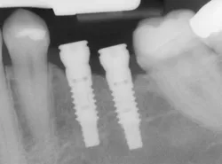 Dental X-ray showing two implant posts between natural teeth