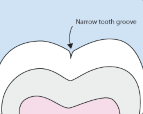 Cross-section of a molar showing a narrow tooth groove where decay can begin
