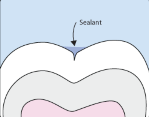 The same molar with a sealant filling the narrow groove