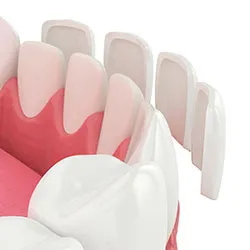 Thin veneers positioned in front of prepared upper teeth